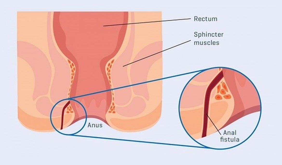 Kshar Sutra treatment for Fistula