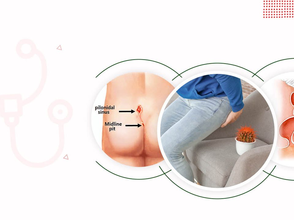 Piles Doctor in Shimla