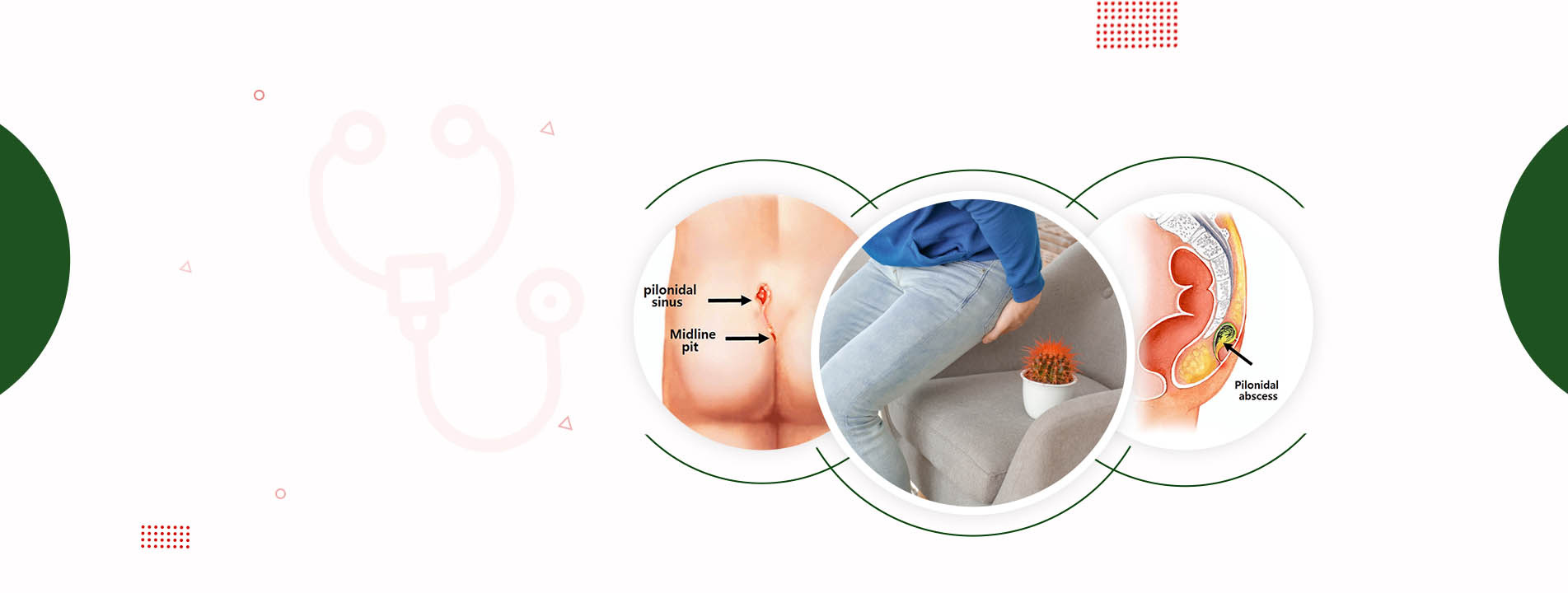 Piles Doctor in Shimla