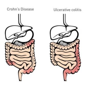 What is Ulcerative Colitis?