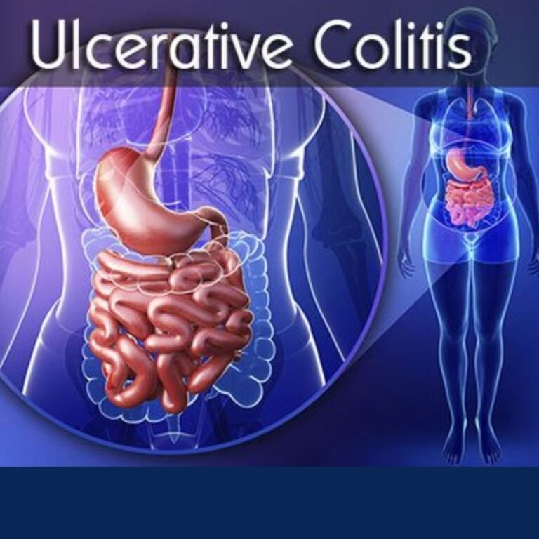 Causes of Ulcerative Colitis
