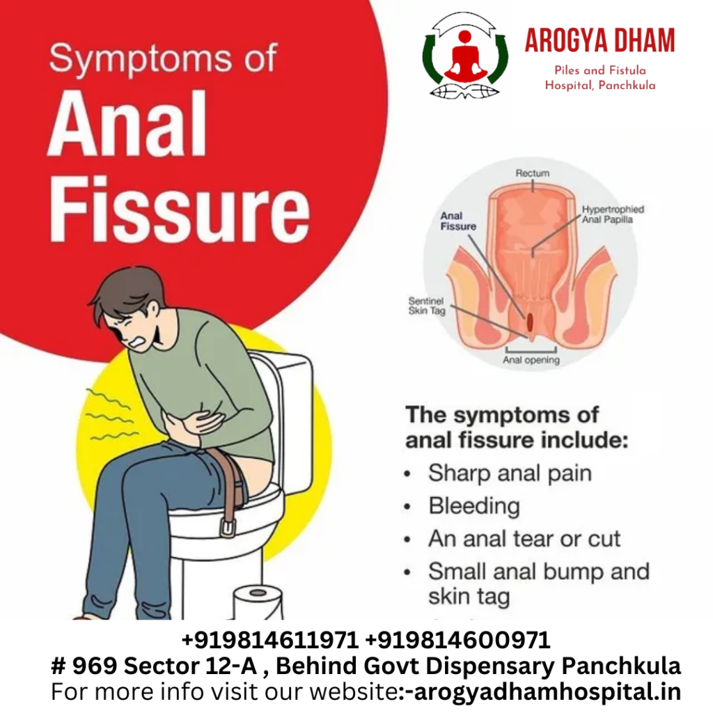 AnalFissure