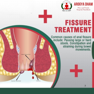 Anal fissure
